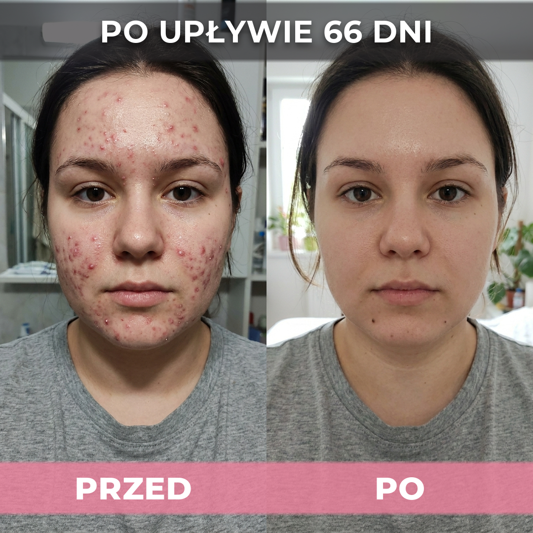 AkneMax (Ekspresowo usuwa trądzik, pryszcze i zaskórniki w zaledwie kilka dni)