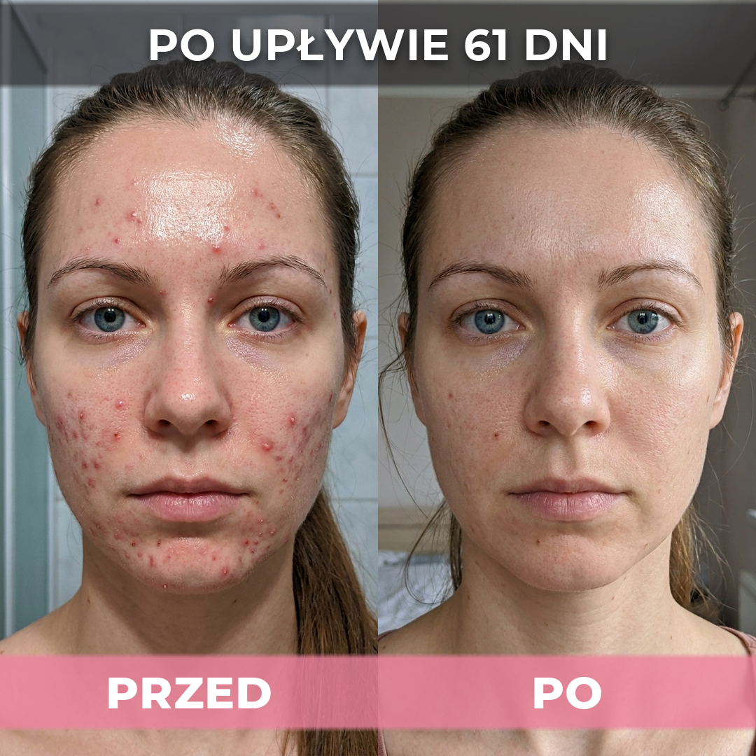 AkneMax (Ekspresowo usuwa trądzik, pryszcze i zaskórniki w zaledwie kilka dni)