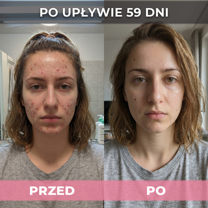 AkneMax (Ekspresowo usuwa trądzik, pryszcze i zaskórniki w zaledwie kilka dni)