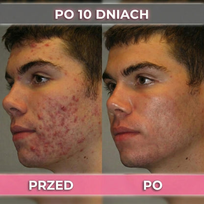 2 op. AkneMax (Ekspresowo usuwa trądzik, pryszcze i zaskórniki w zaledwie kilka dni)