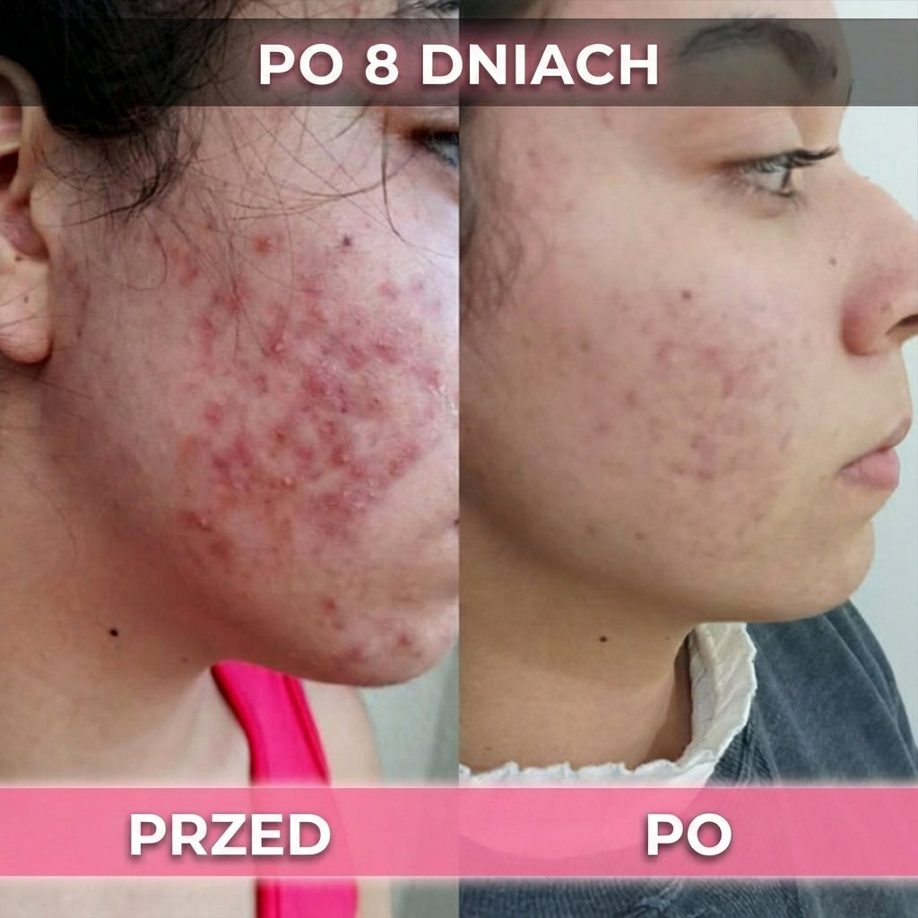 2 op. AkneMax (Ekspresowo usuwa trądzik, pryszcze i zaskórniki w zaledwie kilka dni)
