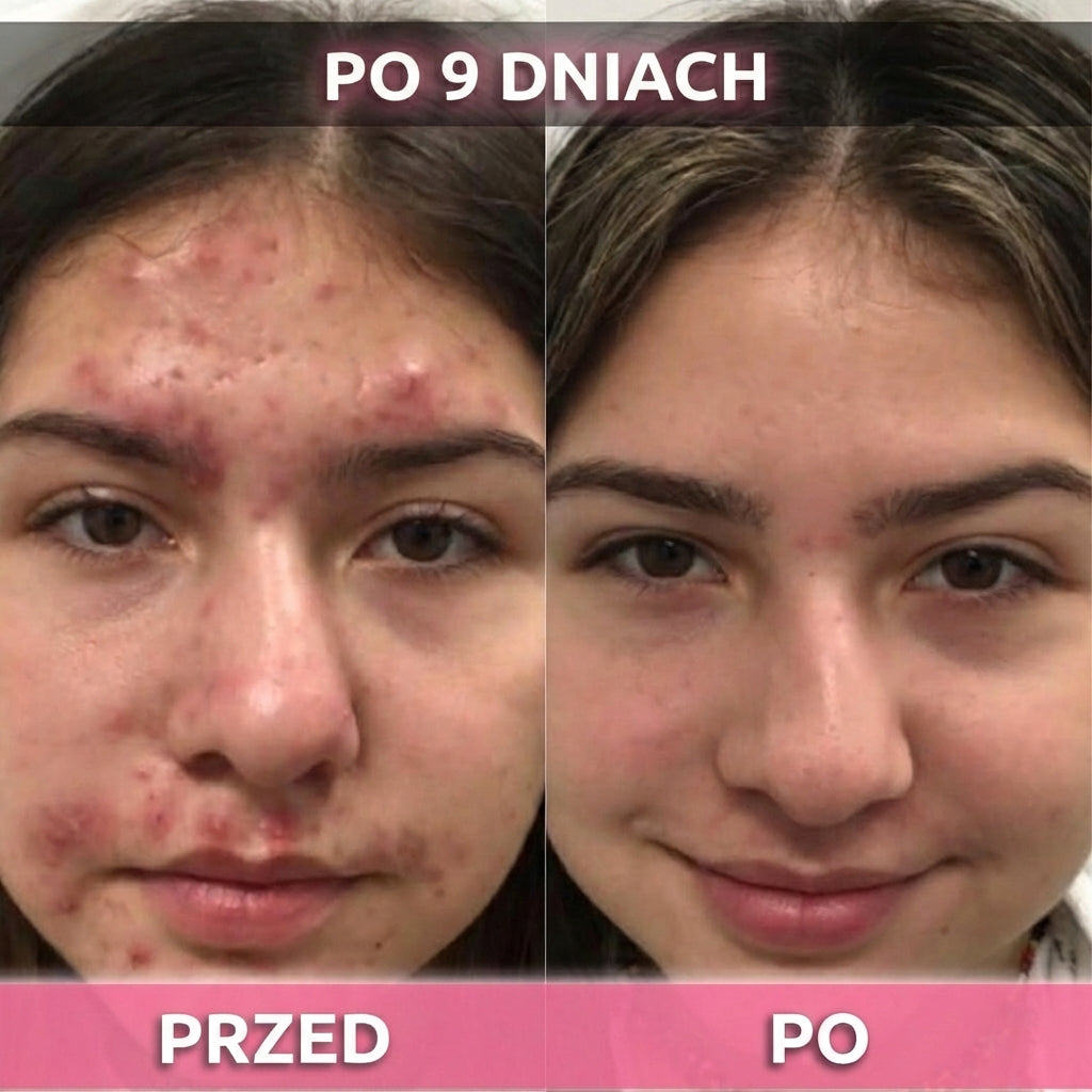 2 op. AkneMax (Ekspresowo usuwa trądzik, pryszcze i zaskórniki w zaledwie kilka dni)